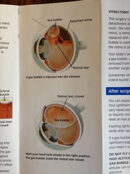 How my detached retina was treated