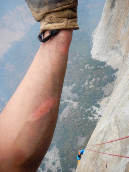 Ryan's arm burn selfie after his 20ft whipper.