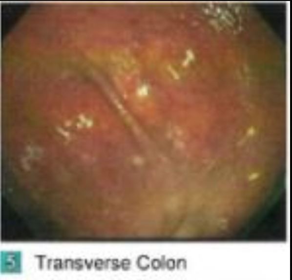Second leg is the transverse colon.  We encountered some polyps here. ...