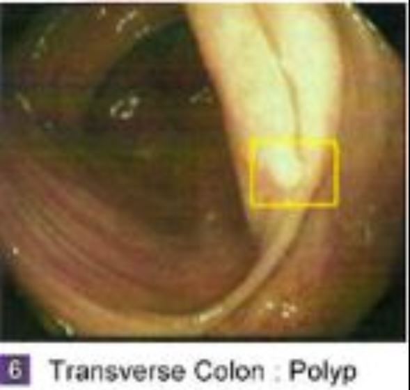 polyp, have to capture and keep moving