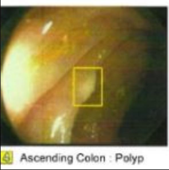more polyps.  I can handle it.