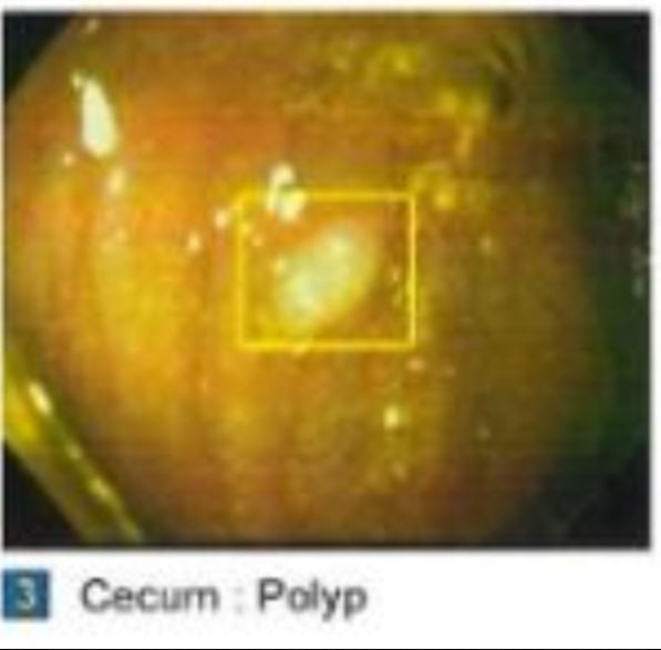 Cecum and the polyps keep showing up.  We are moving on having made ou...