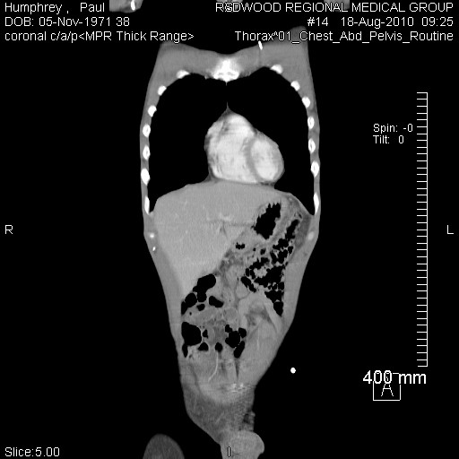 Scan, Aug. 18, post ym155, worst shot.